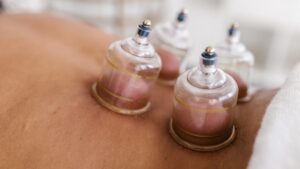 Read more about the article Benefits of Cupping Therapy Combined with Chiropractic