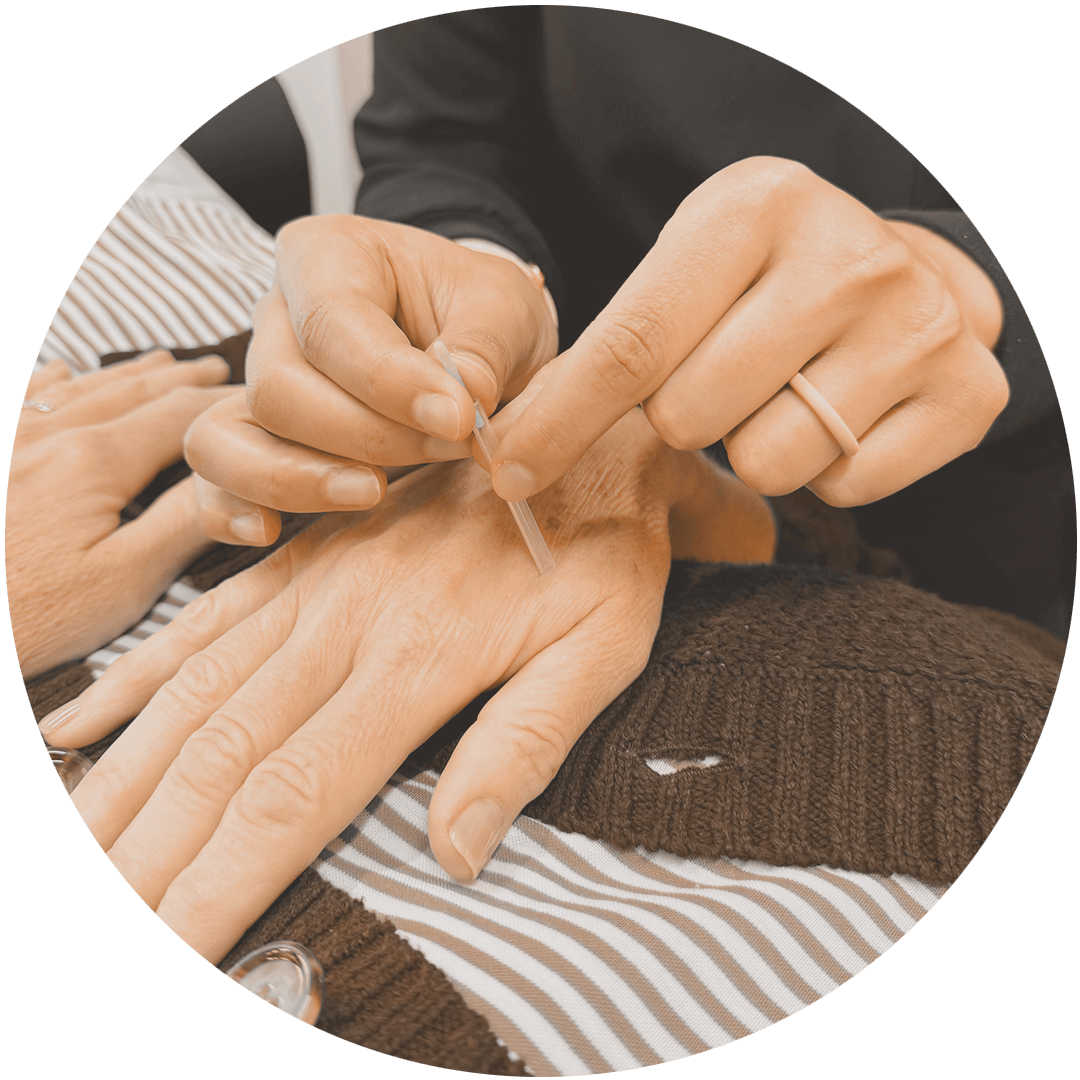 Acupuncture treatment by Dr. Amina Karim at Karim Chiropractic