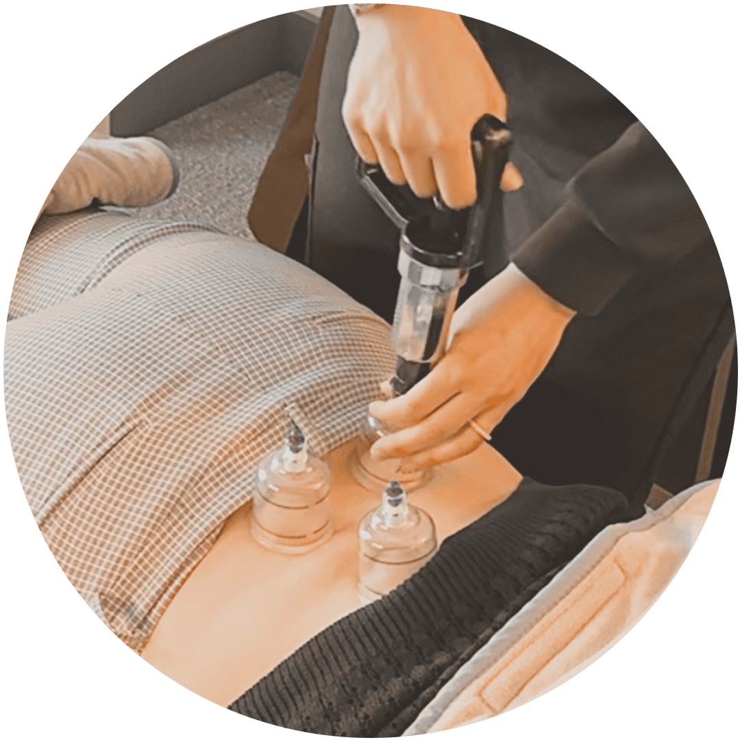 Cupping therapy session provided at Karim Chiropractic in Overland Park